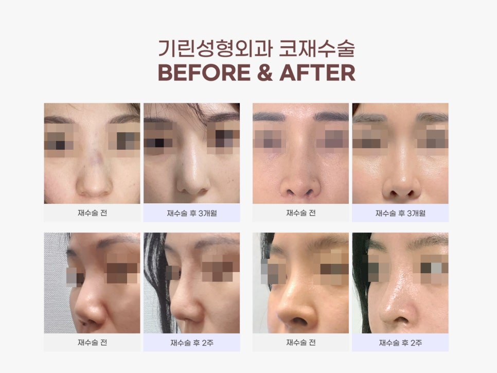 강남코재수술 신중하게 고르자 관련 이미지 3