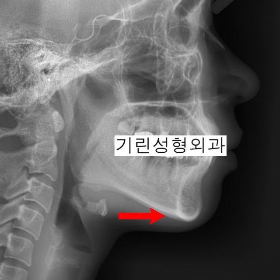 턱이 길거나 발달이 부진한 경우 적합한 턱끝수술 관련 이미지 1