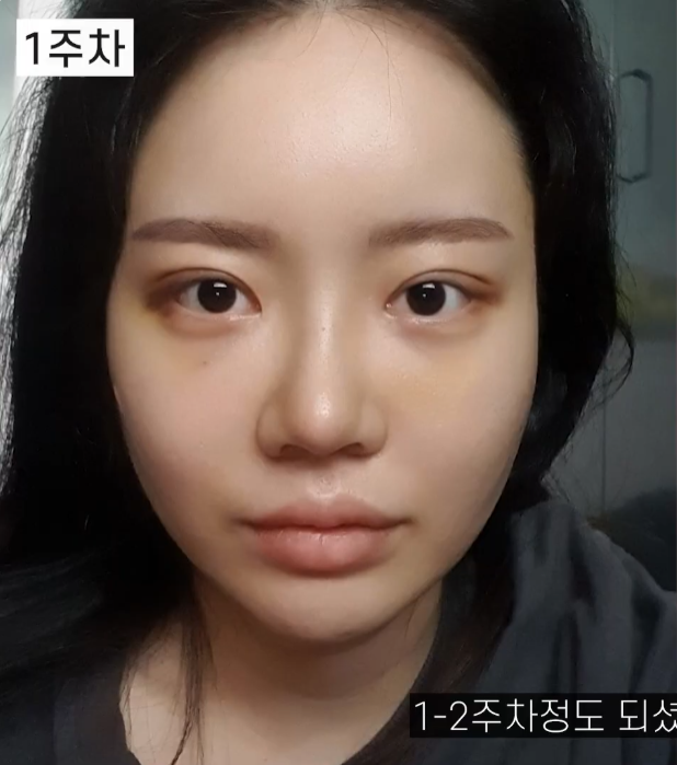 [기린성형외과의원] 코성형 전 코필러 하셨나요?_작은 코성형 수술일지 관련 이미지 5