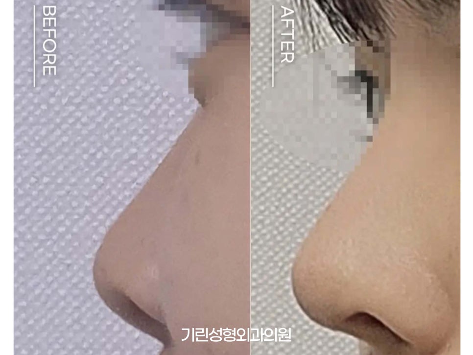 낮은코성형후기 차이점을 고려하여 관련 이미지 4