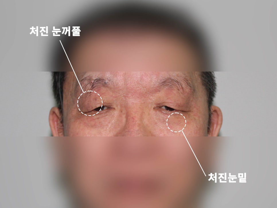 강남눈성형 눈매 개선 만족스럽게 관련 이미지 6