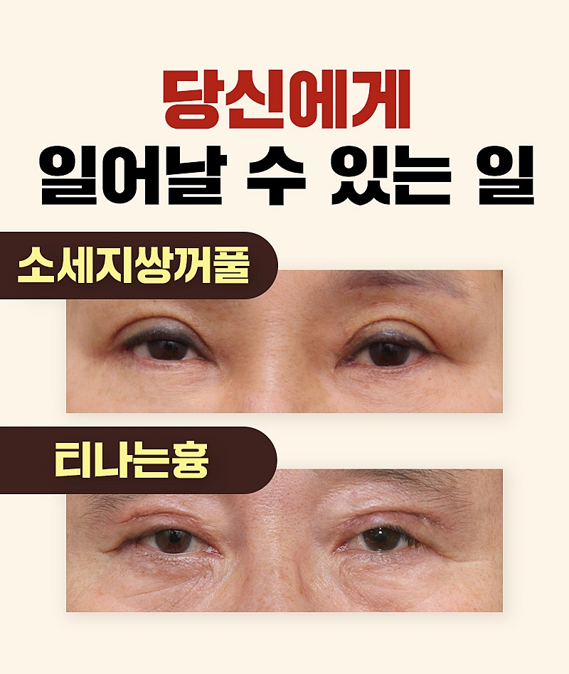 이마눈썹거상술 눈처짐 자연스럽게 눈가 리프팅 효과처럼! 관련 이미지 5