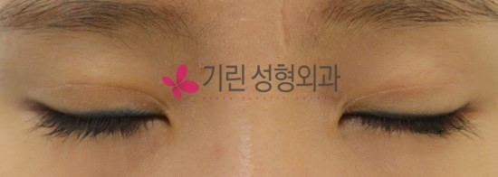 안검하수 (수술 후 6주 눈감은 사진) 관련 이미지 1
