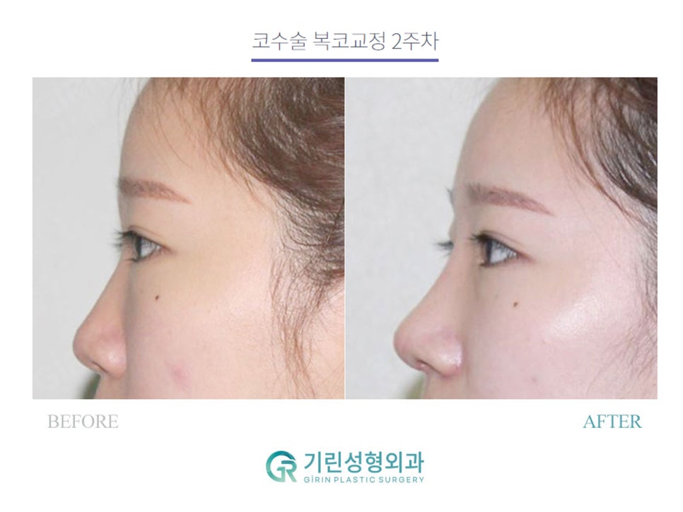 복코수술후기 제대로 찾아야 하는 이유는 관련 이미지 8