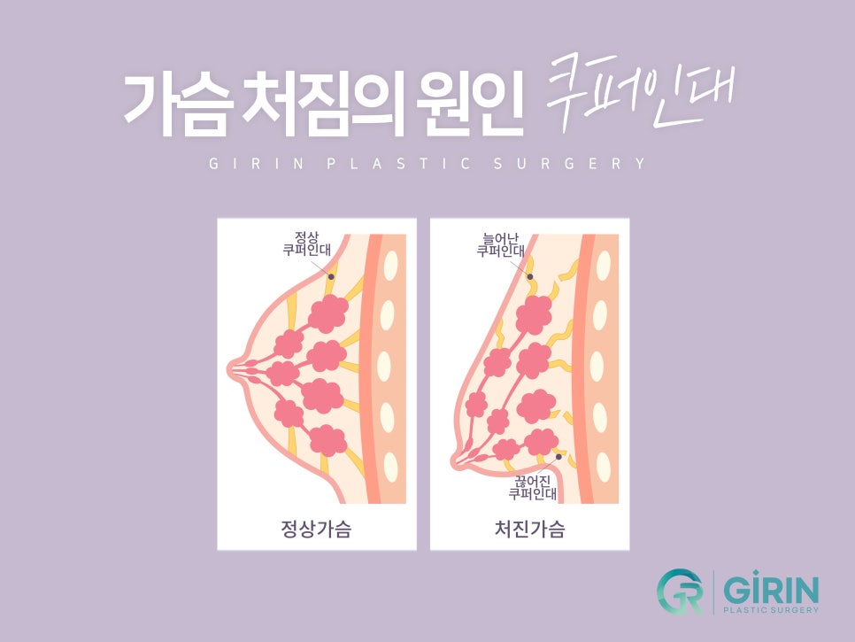 가슴거상술 변화를 기대하며 관련 이미지 2