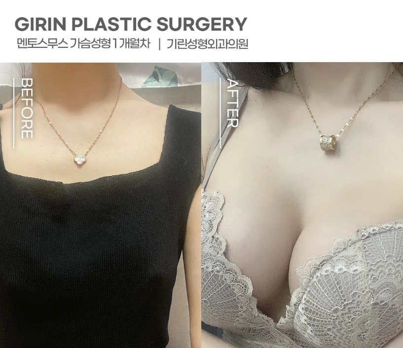 가슴성형외과유명한곳 확실하게 알아보고 관련 이미지 2