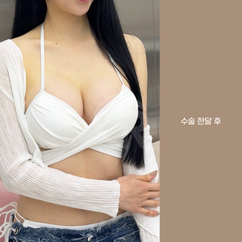 기린성형외과 가슴성형 패션 인플루언서의 고민 해결 관련 이미지 6