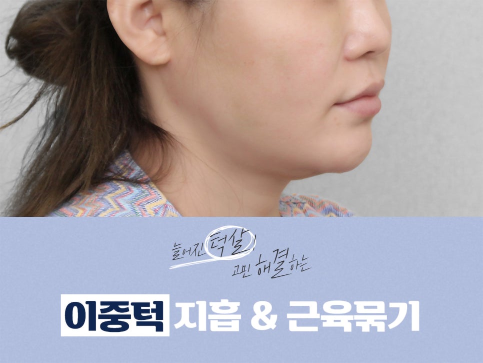 이중턱지흡 생각한다면 관련 이미지 1