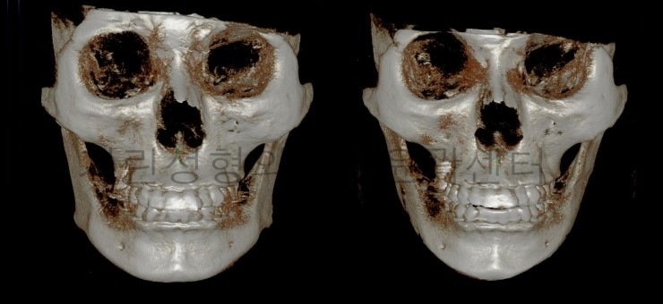 긴곡선+아큐스컬프+귀족수술 7게월 경과 관련 이미지 2