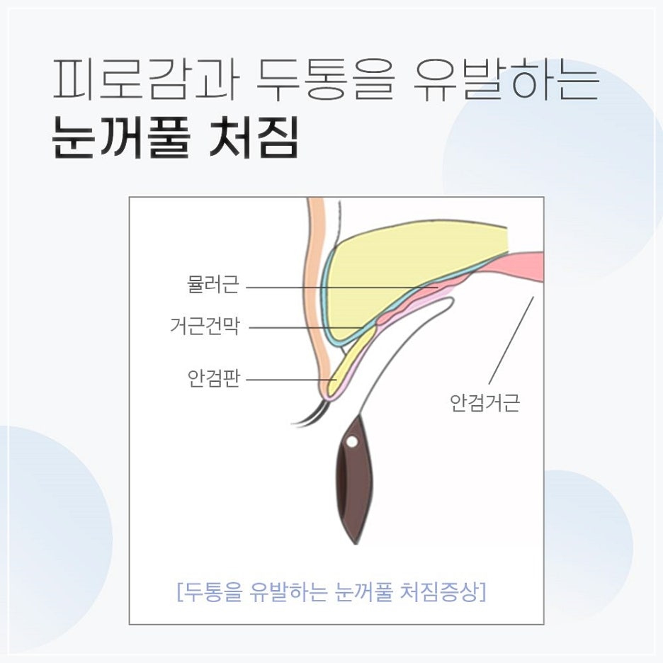 비절개상안검수술 처진중년눈성형 이젠 고민만 하지말자! 관련 이미지 2