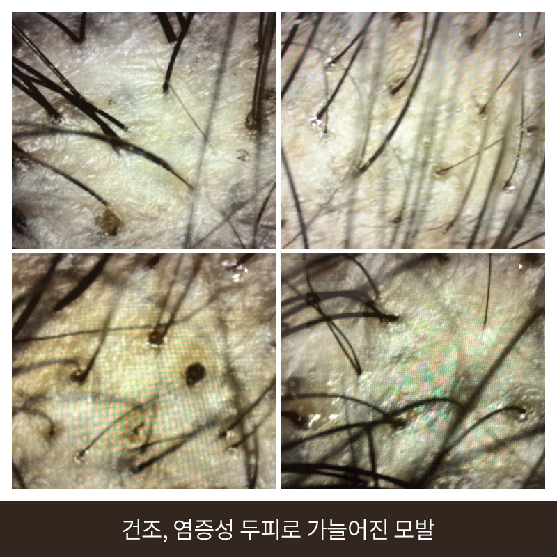 탈모 고민 두피 줄기세포 치료, 가격이 다른 이유는? 관련 이미지 8