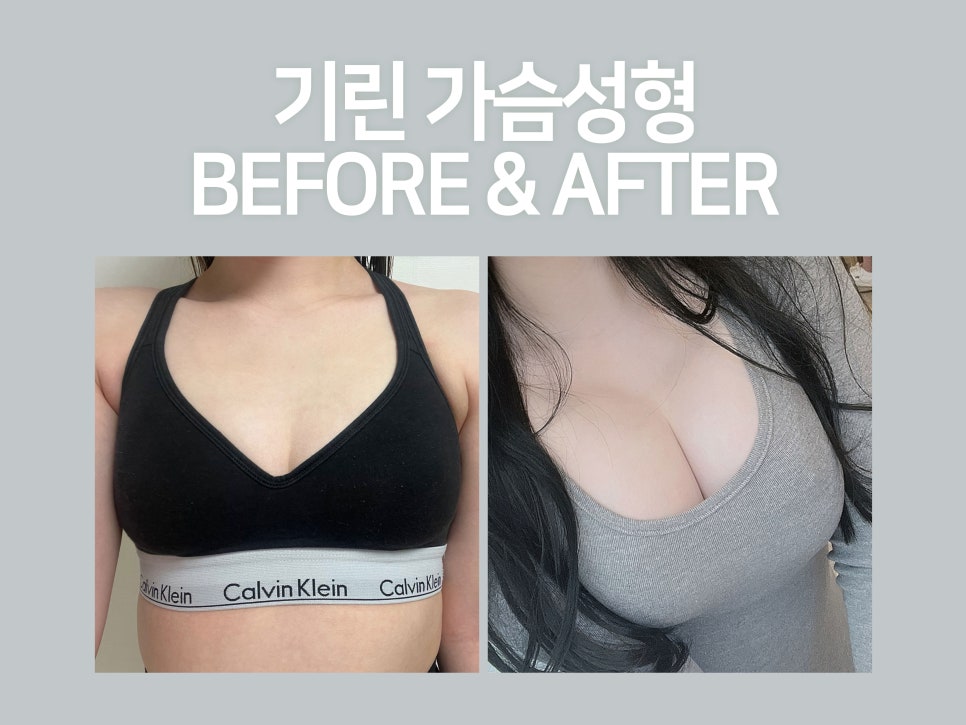 강남가슴성형 자연스러움이 기준 관련 이미지 5