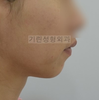 보형물을 이용한 무턱수술과 지방이식을 이용한 방법 관련 이미지 1
