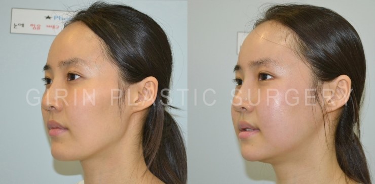 턱길이줄임+브이라인+광대고정술 16일/30일 경과 관련 이미지 3