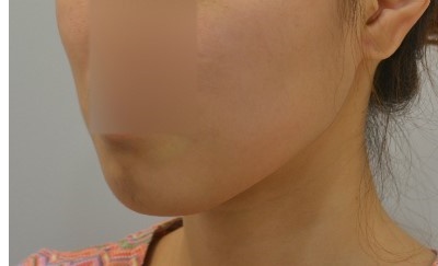 긴턱,무턱,돌출된 복합케이스 양악수술만이 답이 아니다. 관련 이미지 1