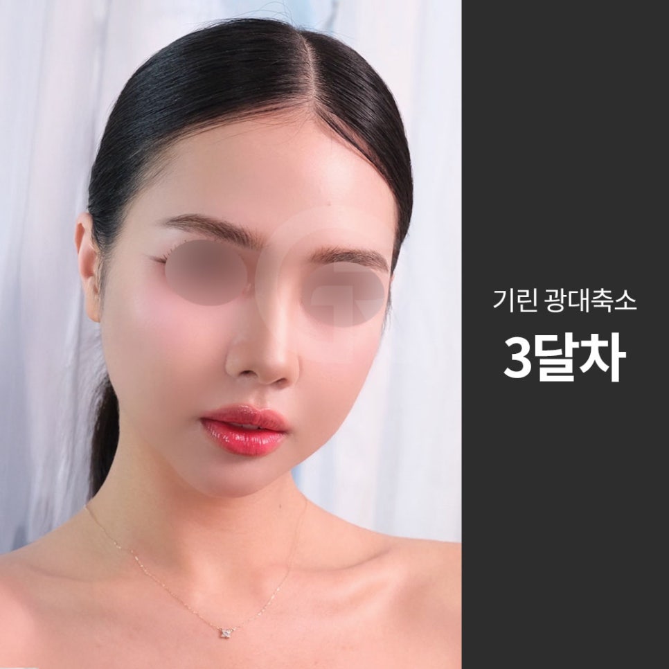 광대가 큰 얼굴, 축소술은 인상을 조율하는 기준점입니다 관련 이미지 6