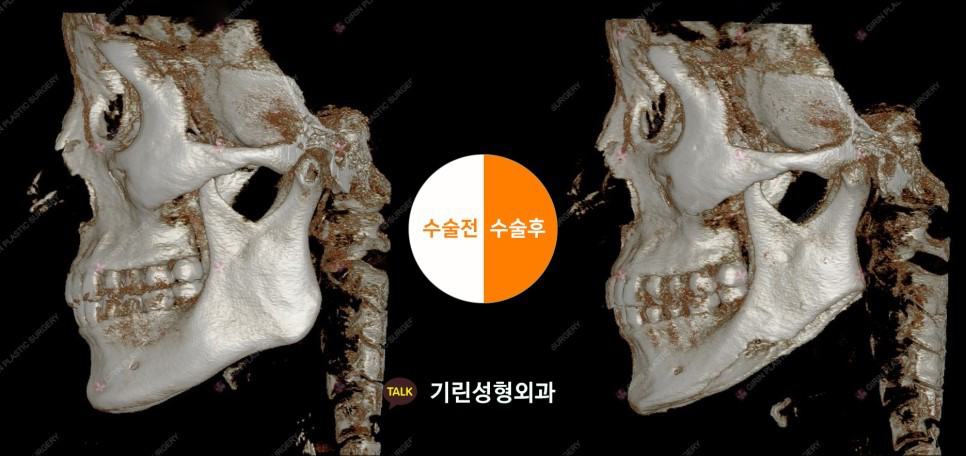 [뉴브이라인]45도 라운딩 브이라인 절골술로 작은 얼굴 만들기 관련 이미지 8