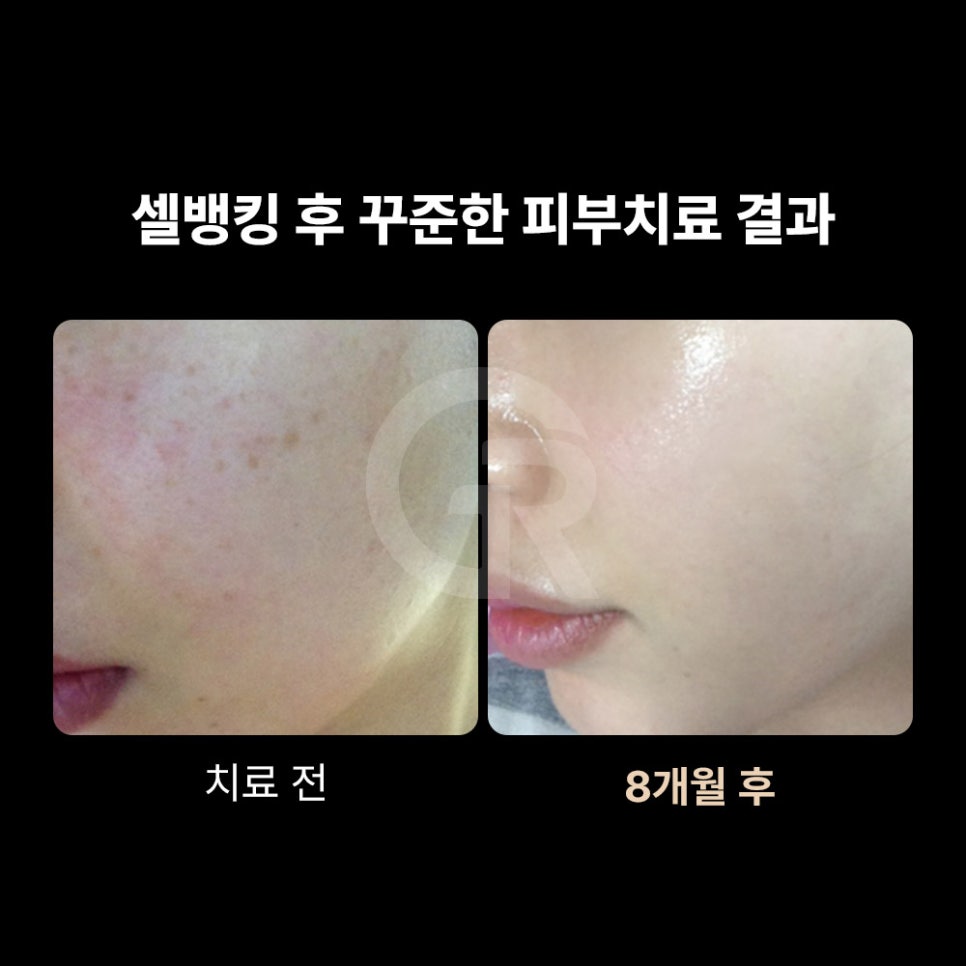 셀뱅킹, 줄기세포 전문 기린성형외과가 제안하는 미래 건강 관리 관련 이미지 2