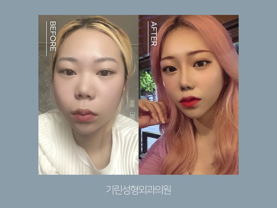 서울코성형 신중하게 정해야 관련 이미지 1