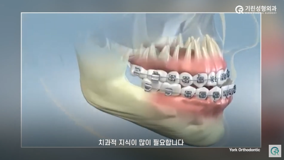 [기린성형외과] 양악수술, 어느 병원으로 가야 성공적이고, 안전할까? 관련 이미지 7