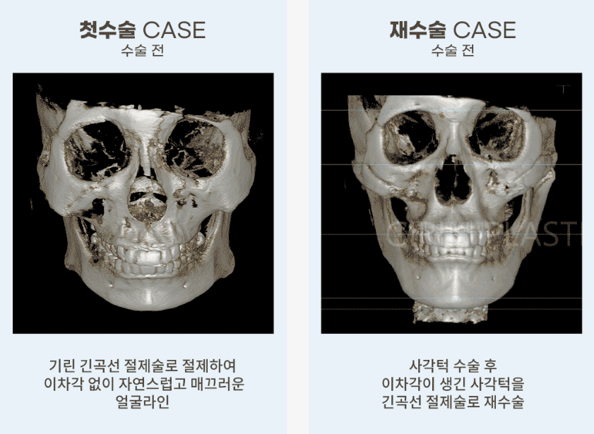 안면윤곽후기? 사실 도움 안 되는 이유 관련 이미지 4