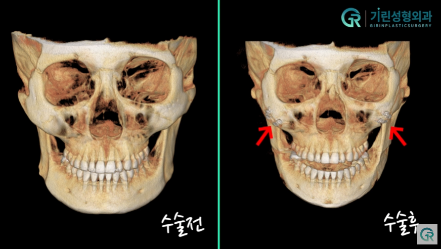 [기린성형외과의원] "카리나가 되고싶어요"_안면윤곽 수술일지 관련 이미지 8