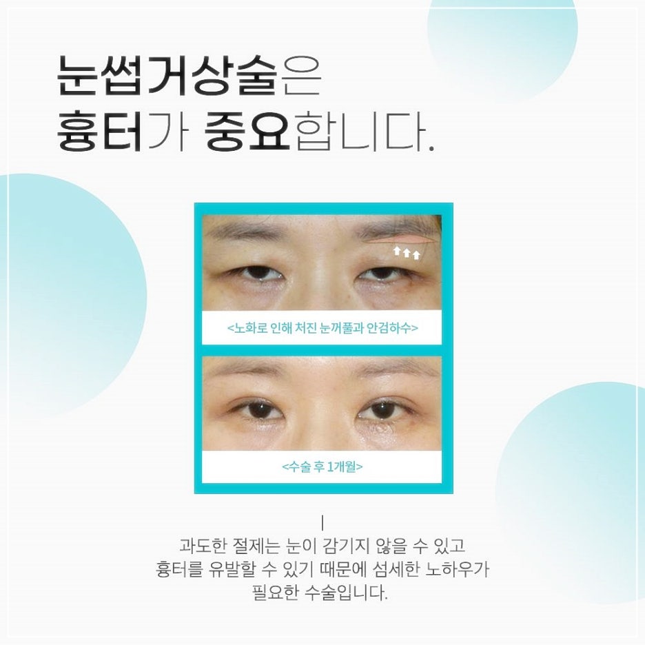 눈썹리프팅 나만알던 동안비결 관련 이미지 6