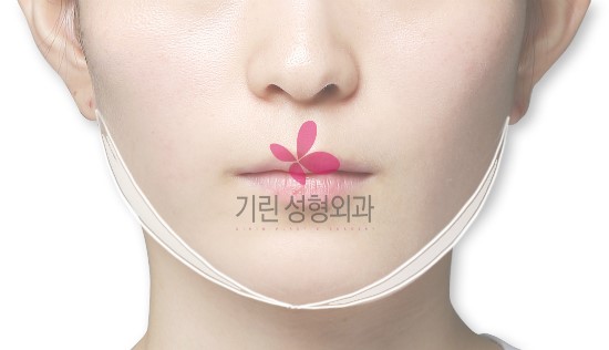 티절골로 제거된 실제 뼈모양과 위치 관련 이미지 5