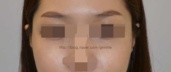 옆광대뼈축소 2달차 붓기정도(B&A) 관련 이미지 2