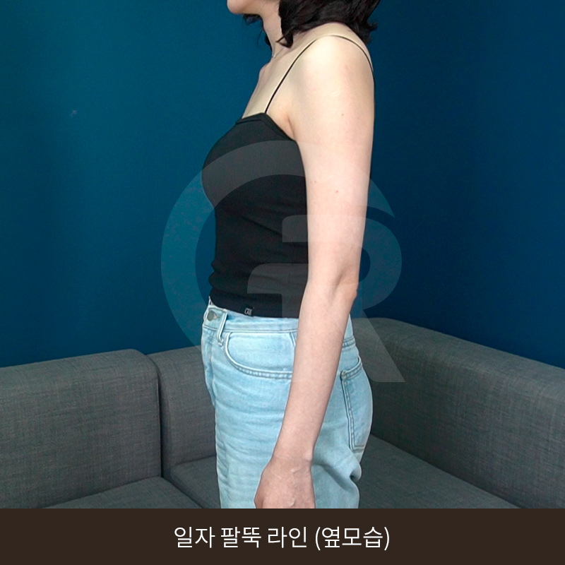 요가로 소용없던 굵은 팔뚝 지방흡입 수술 후기 관련 이미지 14