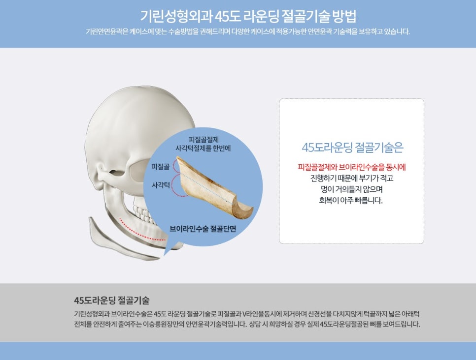 [뉴브이라인] 45도 라운딩 브이라인 절골술로 작은 얼굴 만들기 관련 이미지 4