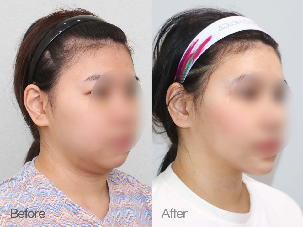 이중턱성형 차이가 궁금하다면 관련 이미지 7