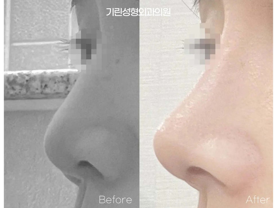 낮은코성형후기 차이점을 고려하여 관련 이미지 2