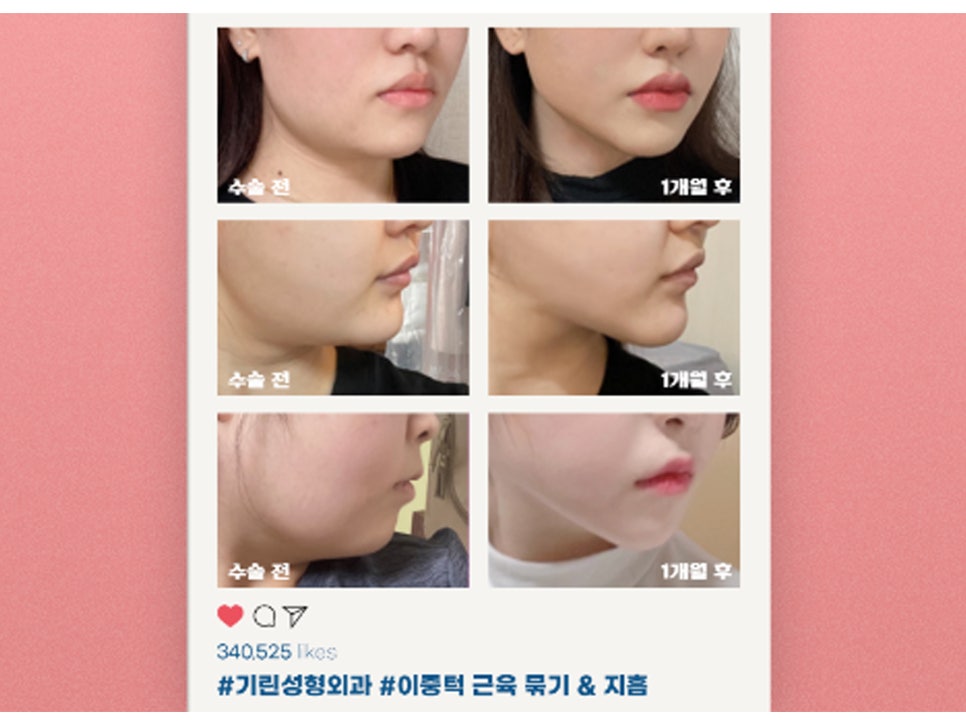 이중턱성형 차이가 궁금하다면 관련 이미지 9