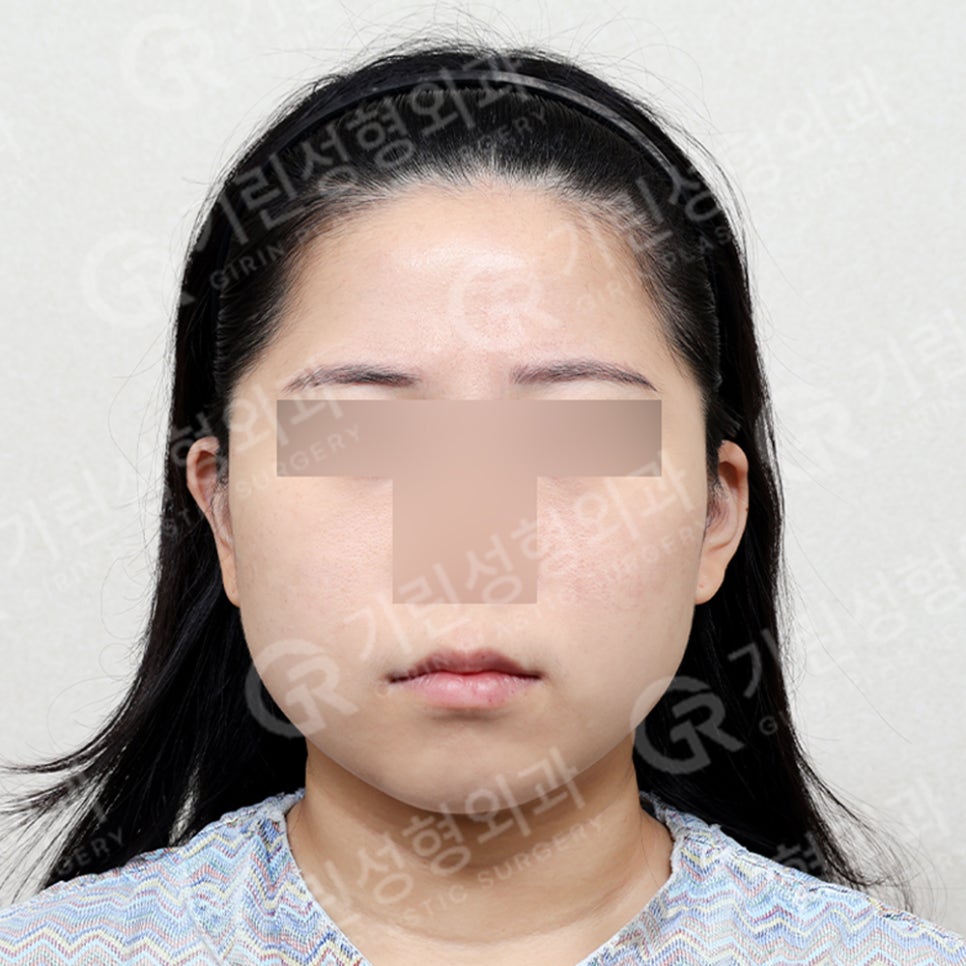 [기린성형외과의원] 누운귀 칼귀 작은귀 고민 해결_엘프귀 요정귀 귀필러 관련 이미지 10