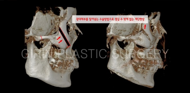 광대축소 불유합과 L절골에 대해 관련 이미지 7