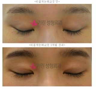 매몰법과 비절개눈매교정의 차이 관련 이미지 3