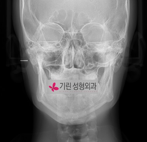 안면형에 맞는 윤곽수술과 효과의 차이 관련 이미지 2