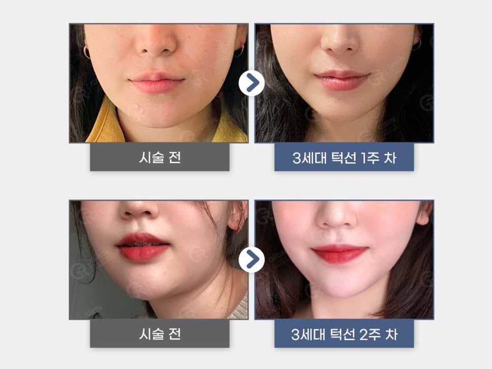 볼살윤곽주사 갸름한 라인 원한다면 관련 이미지 2