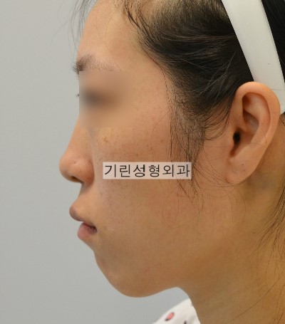 하악왜소증 : 앞으로 빼는 앞턱수술 관련 이미지 1
