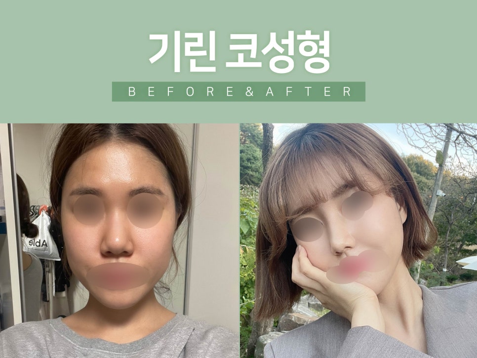 낮은코수술 원하는 라인으로 관련 이미지 9