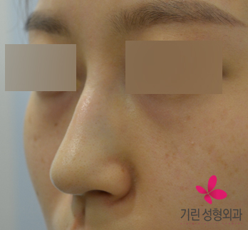 매부리코(+화살코)수술과 귀족수술을 같이 한 경우 관련 이미지 1