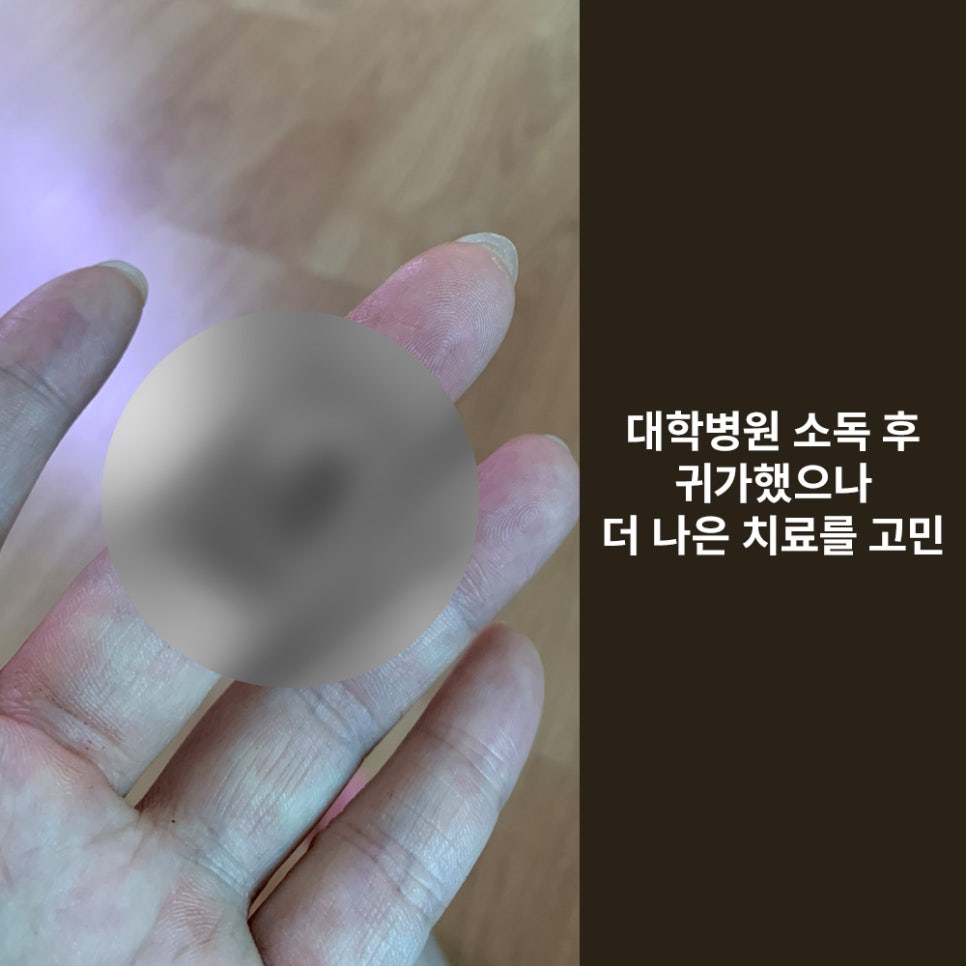 Girin Plastic Surgery for Finger Laceration Suturing, Skin Grafts, and Scar Care image 4