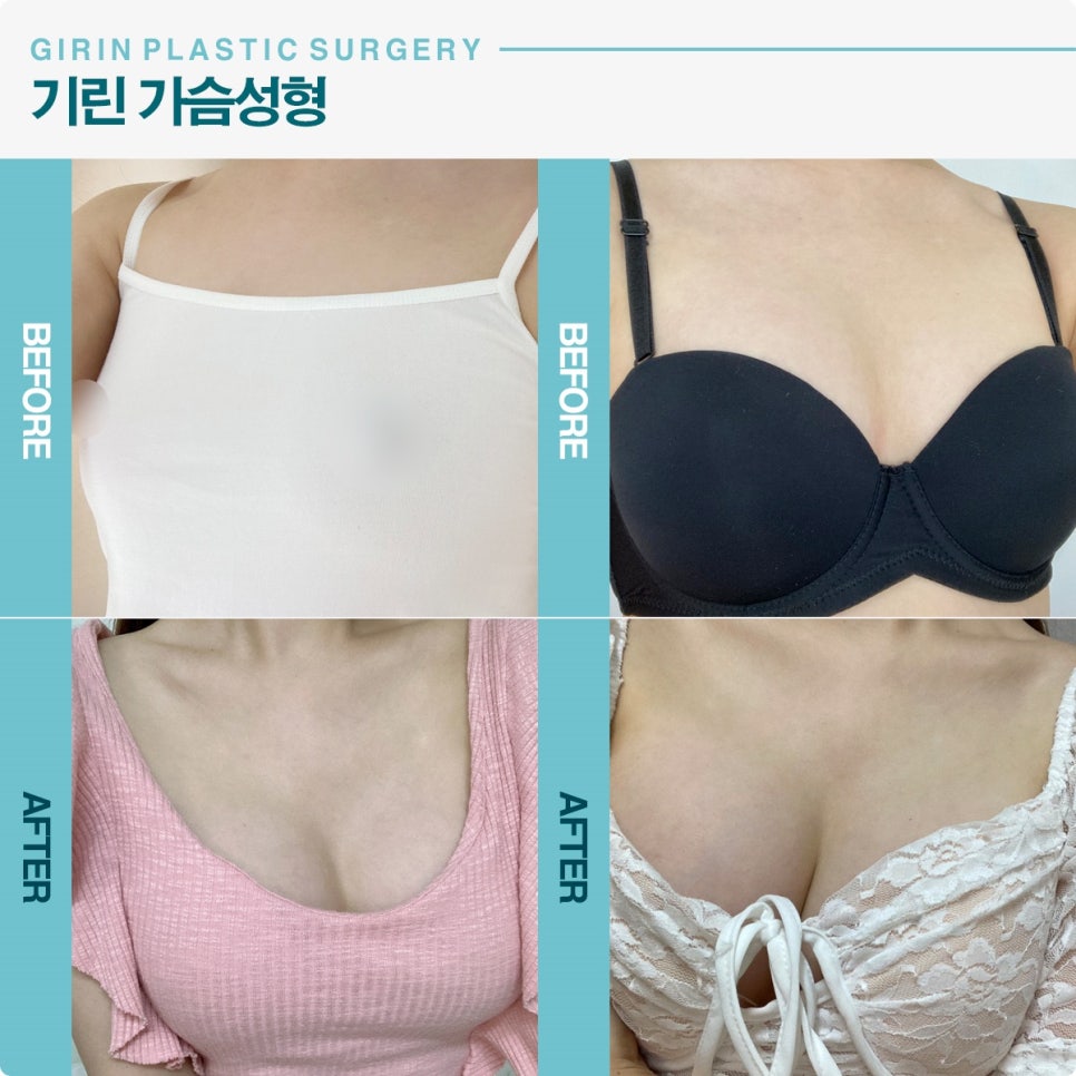 가슴재수술시기, 놓치면 후회 하는 이유 관련 이미지 4