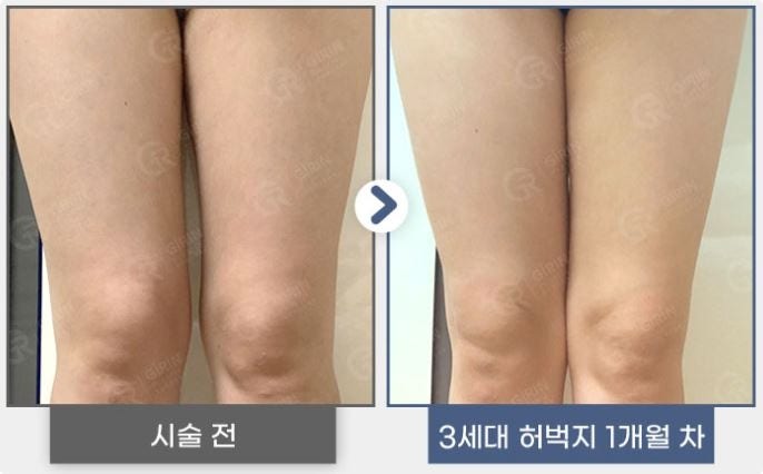 강남지방분해주사, 의미 없는 유형은? 관련 이미지 6