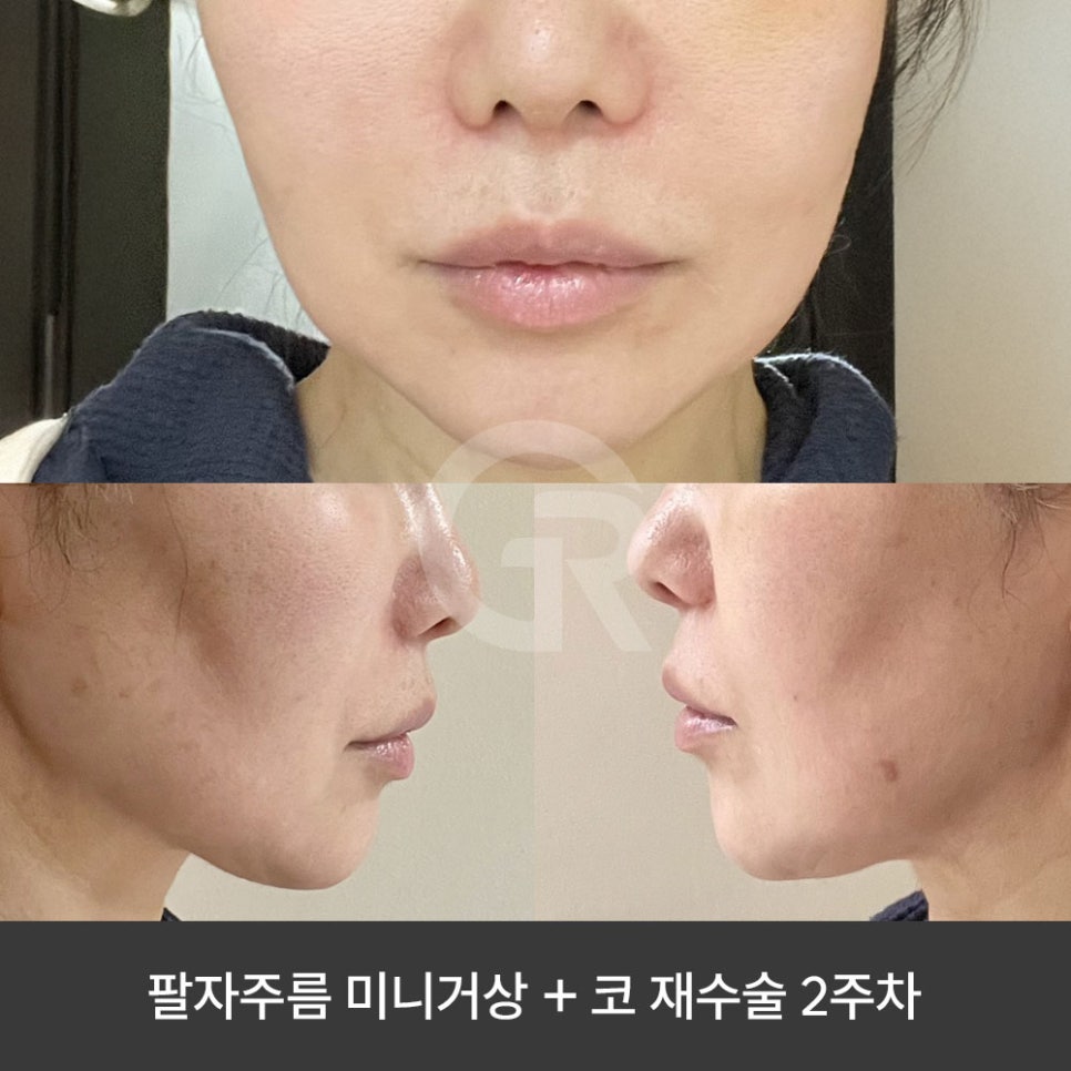 깊은 팔자주름 때문에 미니거상을 진행한 케이스(+코재수술) 관련 이미지 6
