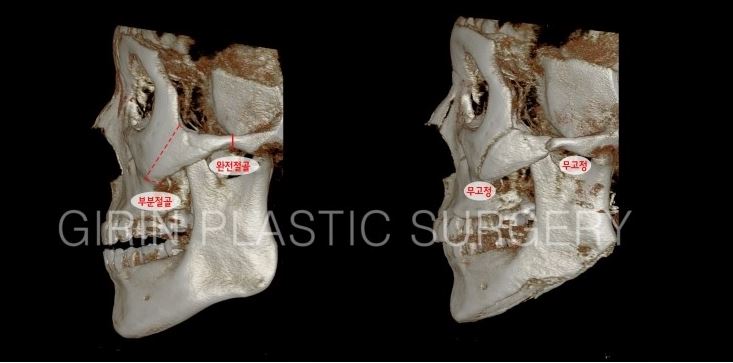 케이스에 맞는 광대뼈축소술 관련 이미지 5