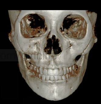 케이스에 맞는 광대뼈축소술 관련 이미지 8