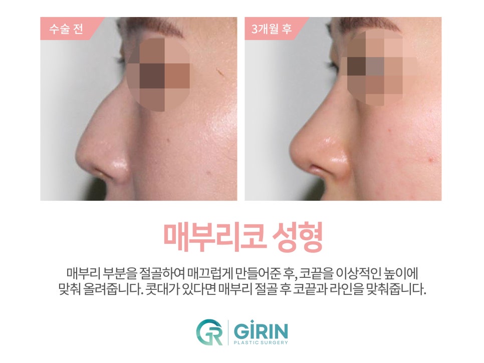 여자코수술 모양도 고려하여 관련 이미지 8