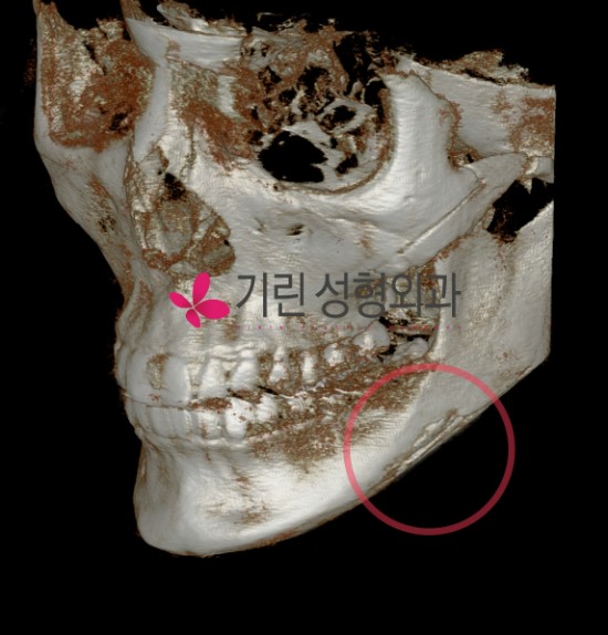 3DCT로 피질절골술 범위 확인방법 관련 이미지 2